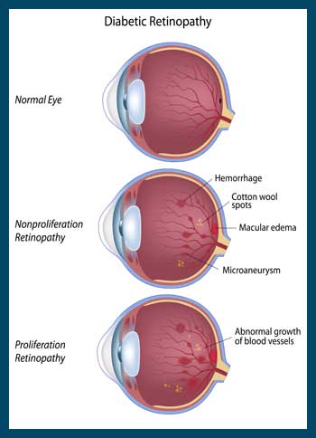 Diabetic Retinopathy