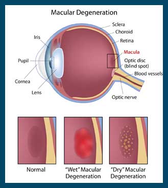 Macular Degenration in Reno